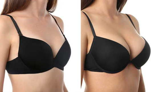 Mamoplastia de Aumento