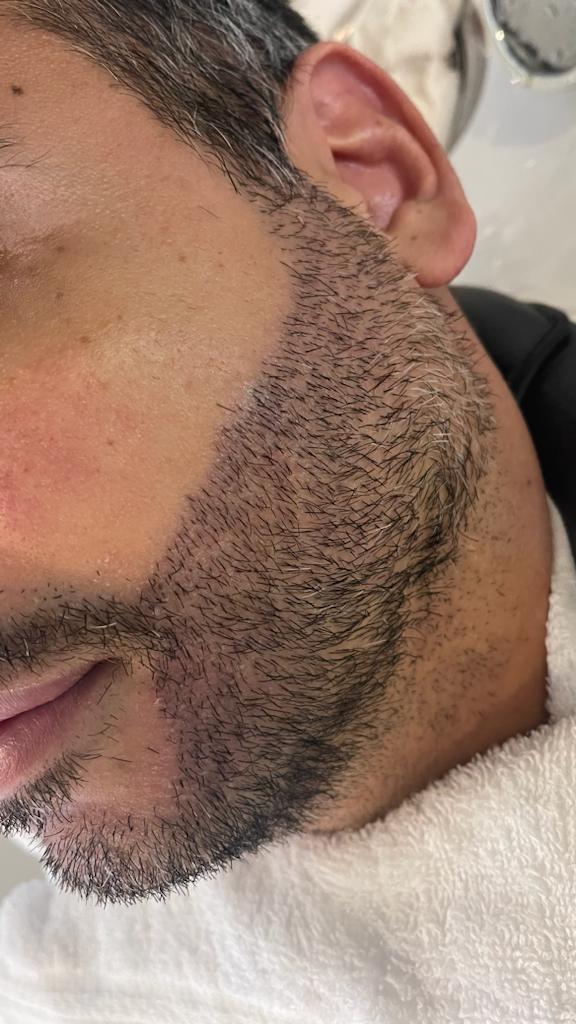 Transplante de barba cresce no mercado masculino